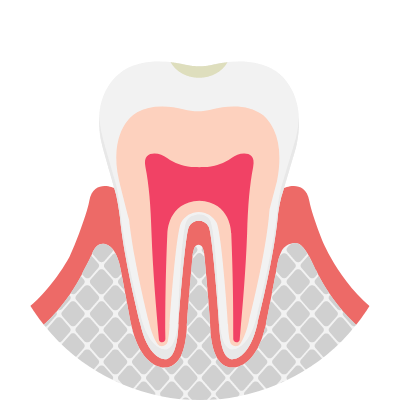 初期段階のむし歯
