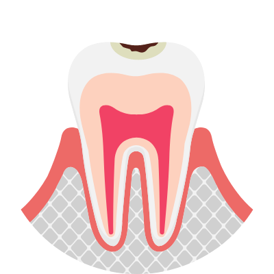 虫歯の進行が歯の表面に限局しているむし歯