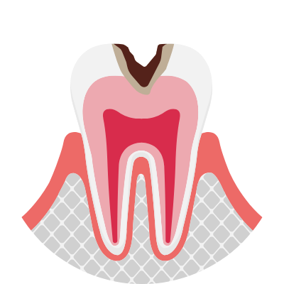 虫歯の進行が象牙質まで及んでいるむし歯