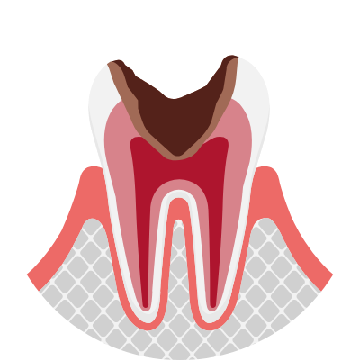 虫歯の進行が歯の神経まで及んでいるむし歯