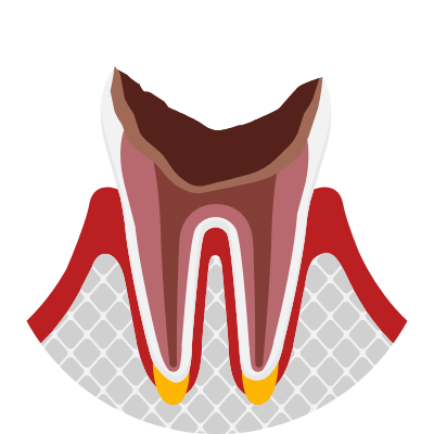 虫歯の進行が歯の大部分を占める状態