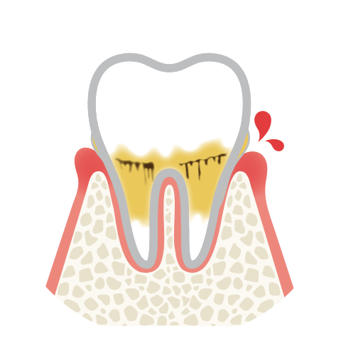 歯茎に炎症が起き、歯周ポケットが3㎜程度の状態