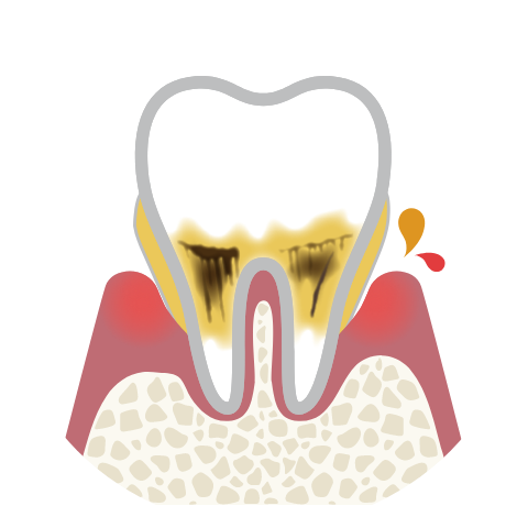 さらに骨の溶ける量が増えて歯周ポケットが6㎜以上の状態