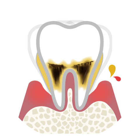 歯を支える骨がほとんどなく、歯に著しい動揺を認める状態